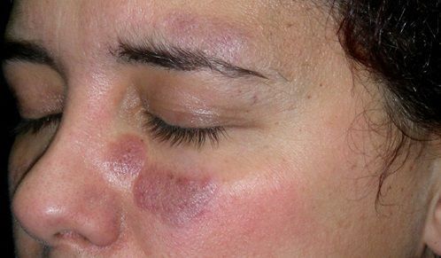 Συστηματικός ερυθηματώδης λύκος: Ποια είναι τα ύπουλα συμπτώματα