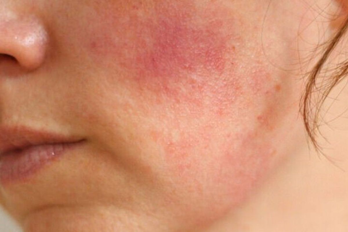 Συστηματικός ερυθηματώδης λύκος: Ποια είναι τα ύπουλα συμπτώματα