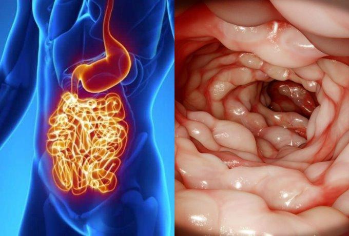 Νόσος-Crohn- Νόσος-Crohn-