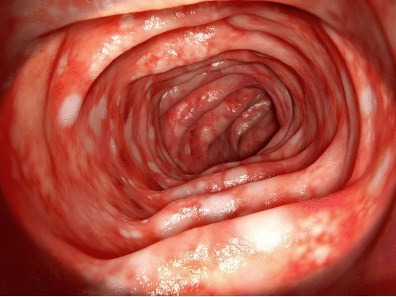 Νόσος-Crohn- Νόσος-Crohn-