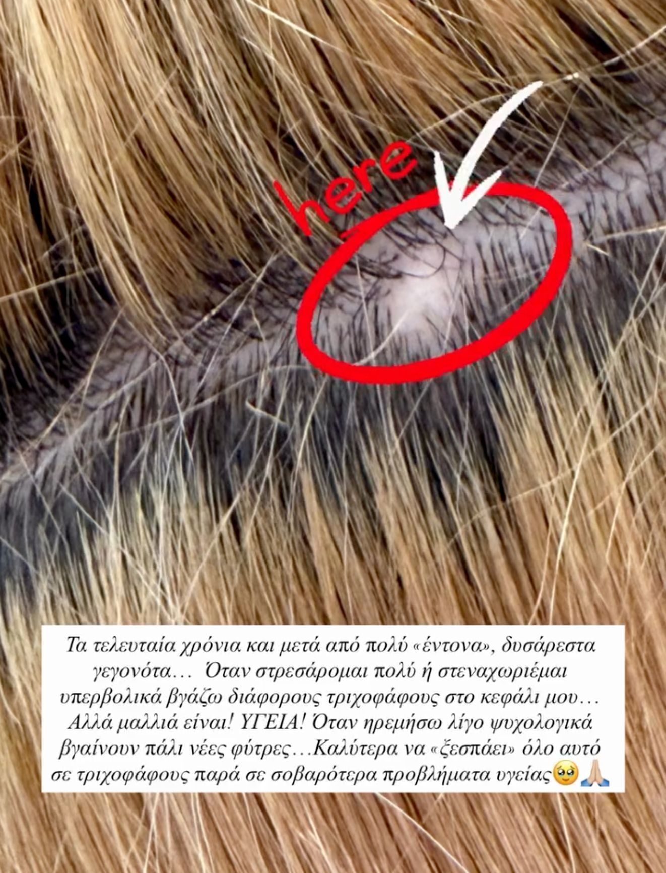 Η Ιωάννα Τούνη αποκαλύπτει την αυτοάνοση πάθηση από την οποία πάσχει τα τελευταία χρόνια