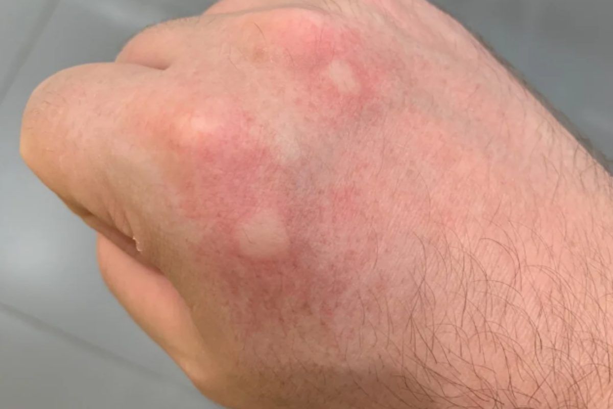 τσίμπημα-από-κουνούπι-