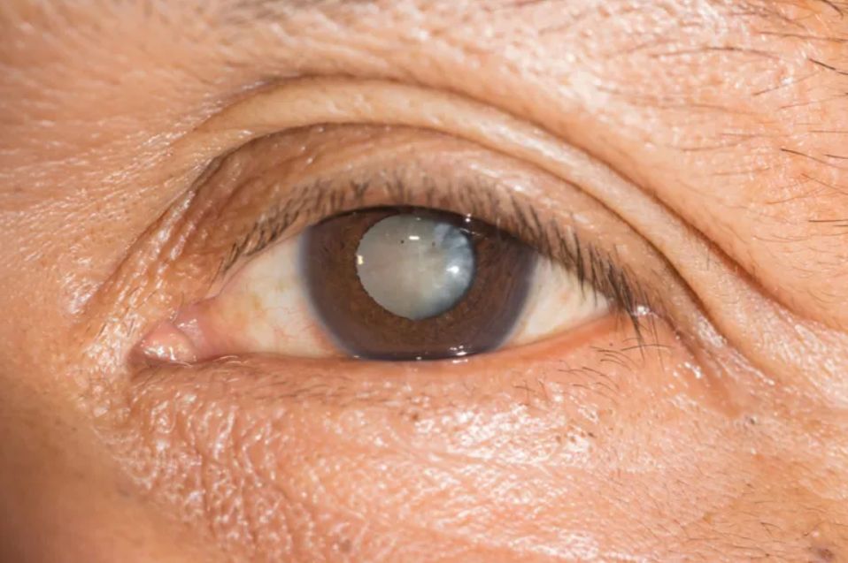 Μεγάλη προσοχή: Αν θολώνουν τα μάτια σου μπορεί να έχεις καταρράκτη