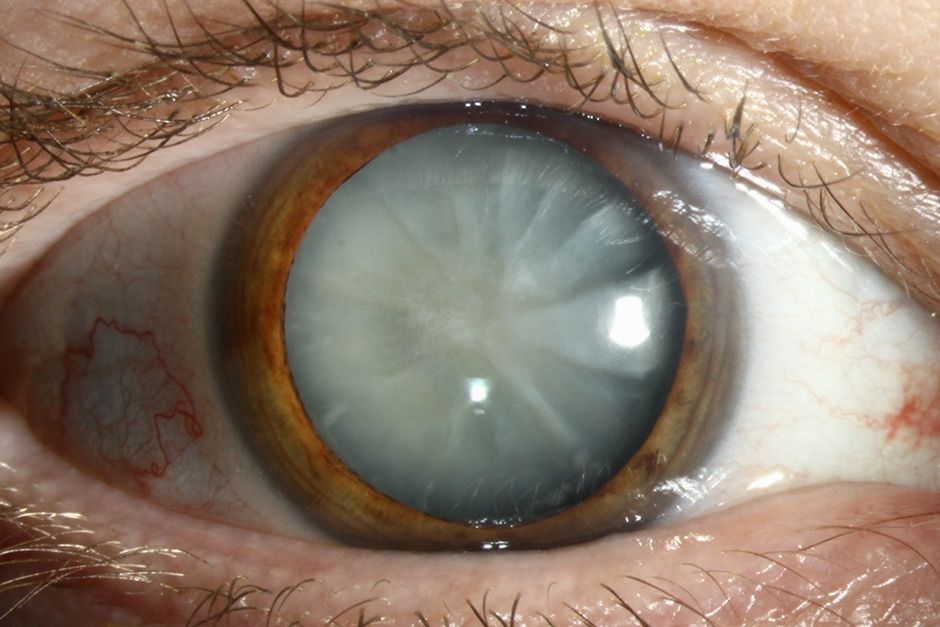 Μεγάλη προσοχή: Αν θολώνουν τα μάτια σου μπορεί να έχεις καταρράκτη