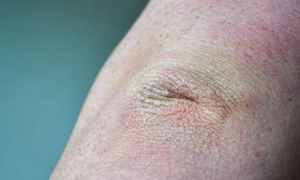 σκασμένοι-αγκώνες- σκασμένοι-αγκώνες-