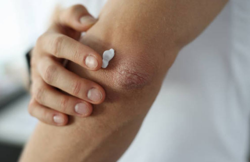 σκασμένοι-αγκώνες- σκασμένοι-αγκώνες-