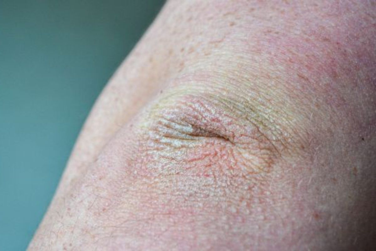 σκασμένοι-αγκώνες-