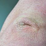 σκασμένοι-αγκώνες-