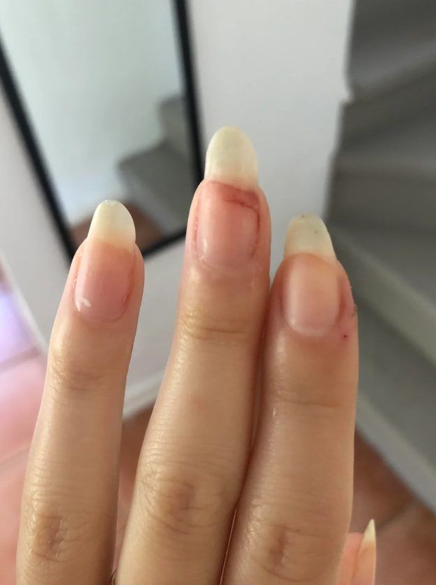 σπασμένα-νύχια-με-μελανιά-