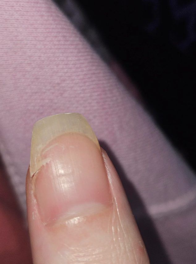 σπασμένο-νύχι-