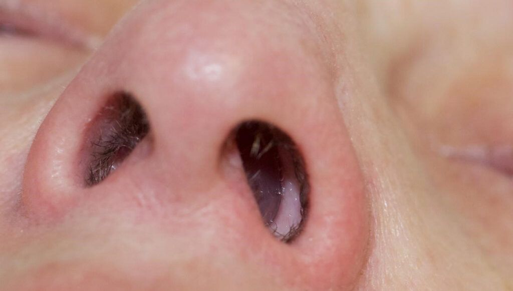 πολύποδας-στη-μύτη- πολύποδας-στη-μύτη-