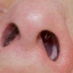 πολύποδας-στη-μύτη-