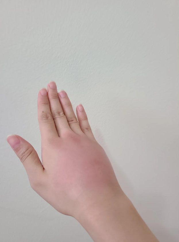 πρησμένο-χέρι- πρησμένο-χέρι-