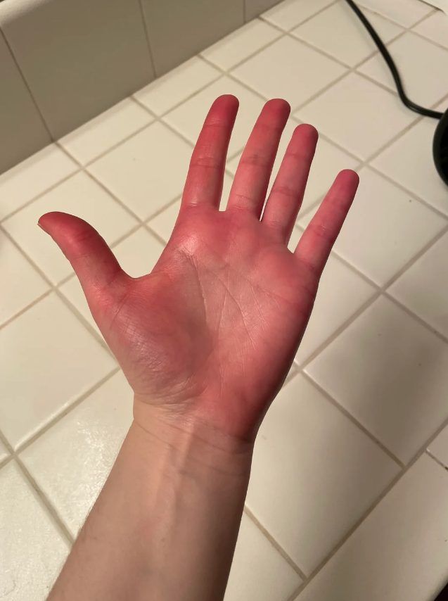 κόκκινη-παλάμη- κόκκινη-παλάμη-