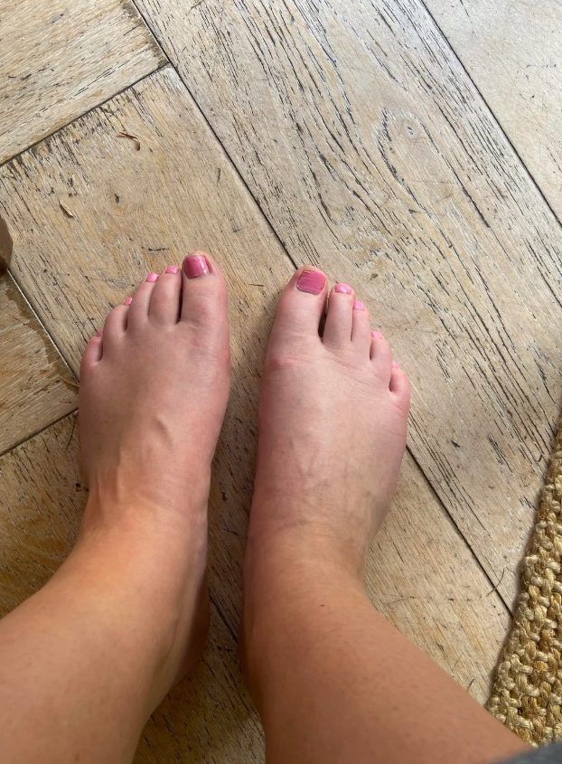 πρησμένα-πόδια- πρησμένα-πόδια-