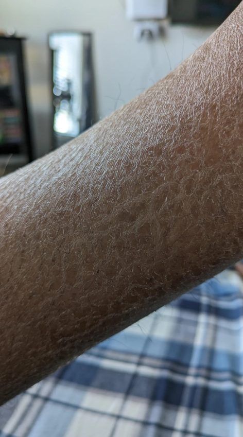 ξηροδερμία-στο-χέρι-