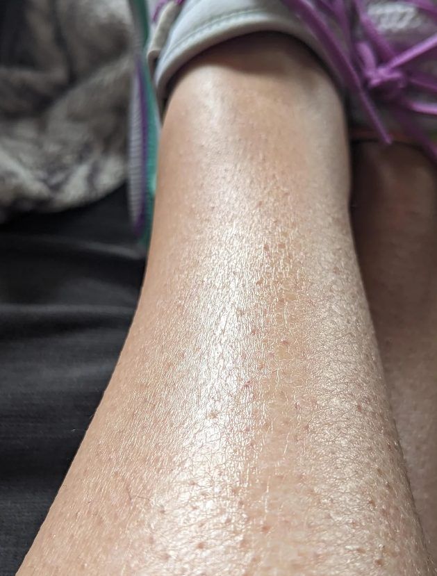 ξηροδερμία-στο-πόδι-