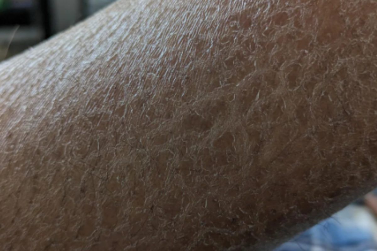 ξηροδερμία-