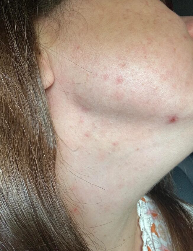 ακμή-στο-πρόσωπο-