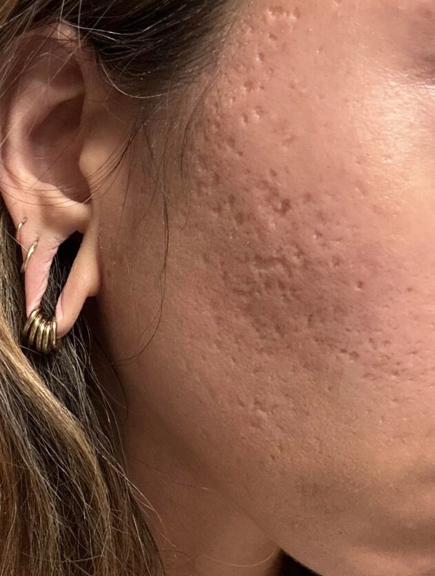 σημάδια-στο-πρόσωπο-από-ακμή-