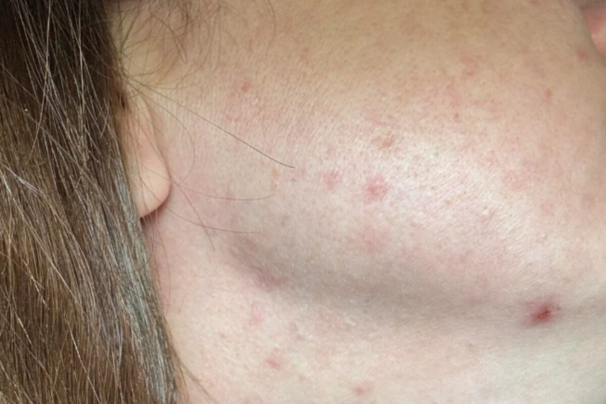 σπυράκια-στο-πρόσωπο-