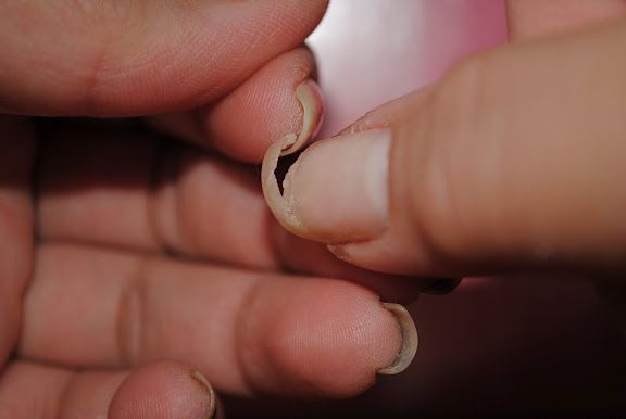σπασμένο-νύχι-