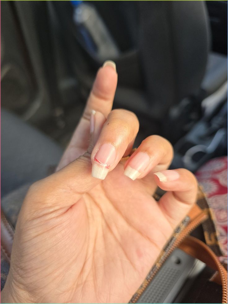 σπασμένο-νύχι-με-πληγή-