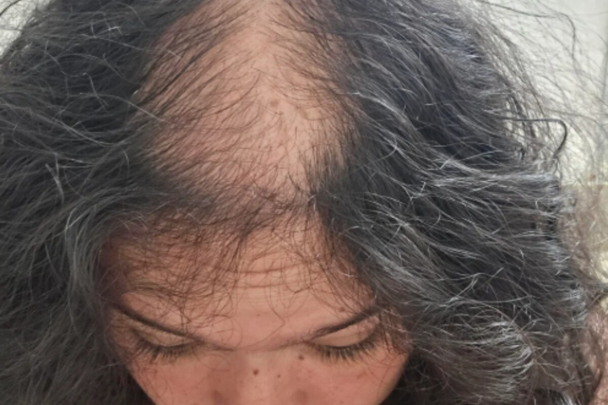 αραίωση-στα μαλλιά-λόγω-χαμηλου-σιδήρου