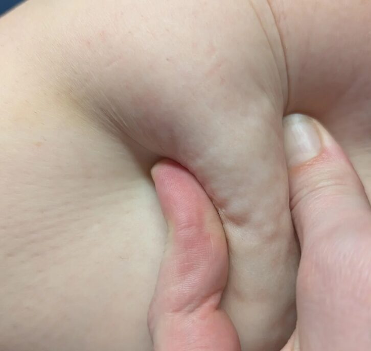 Διατροφή για κυτταρίτιδα – αιτίες & αντιμετώπιση (οδηγός) αφτιαχτο