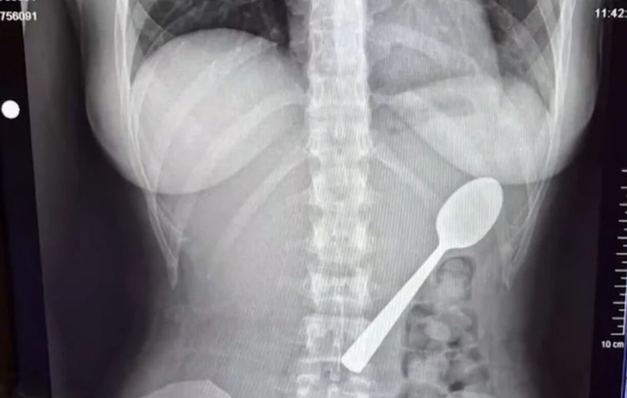 Κατάπιε κουτάλι 17 εκατοστών και κόλλησε στο στήθος της - «Δεν ένιωθα καμία ενόχληση, οπότε δεν ανησύχησα»