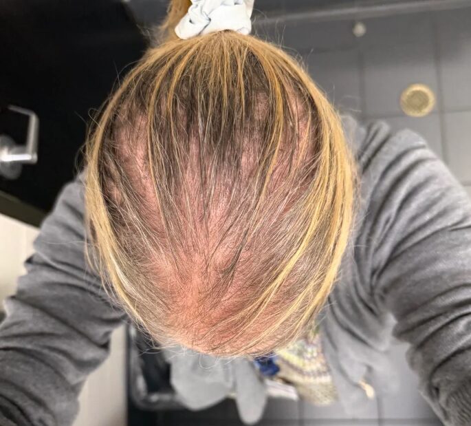 γυναίκα-με-αραίωση-