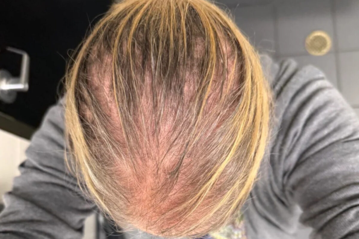 γυναίκα-με-τριχόπτωση-