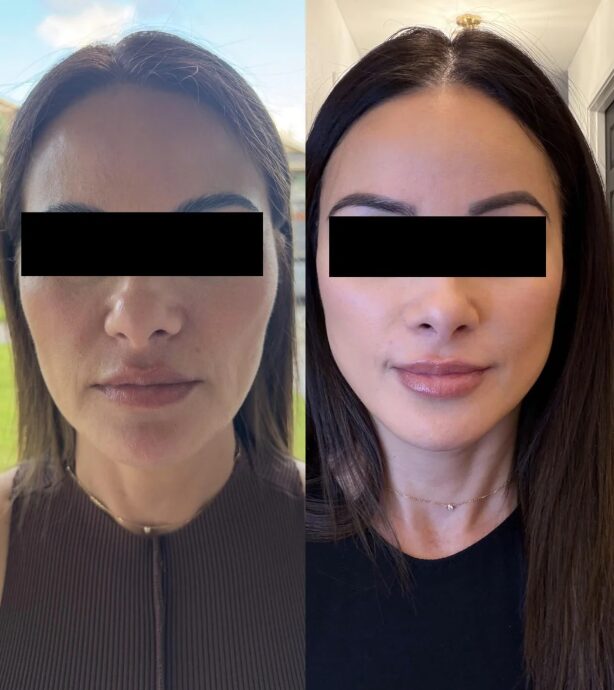 Το μυστικό των supermodels για άμεσο lifting αφτιαχτο