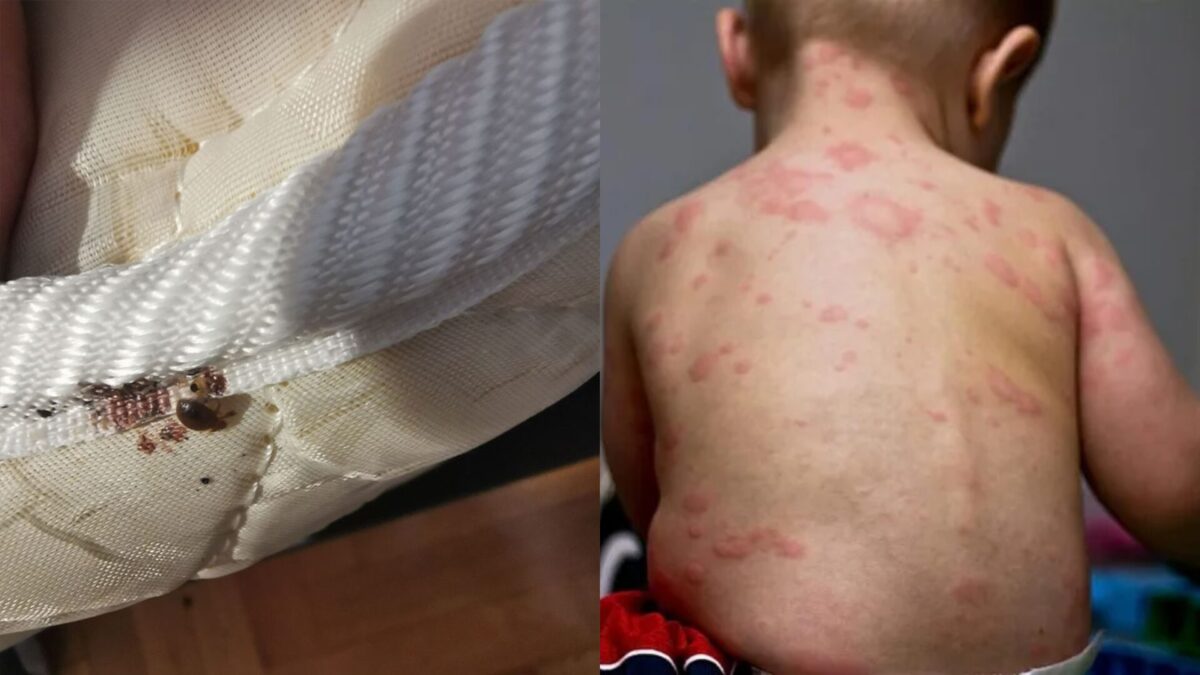 Τσιμπήματα απο έντομα στο κρεβάτι: Δείτε εικόνες και αναγνωρίστε τι σας τσίμπησε