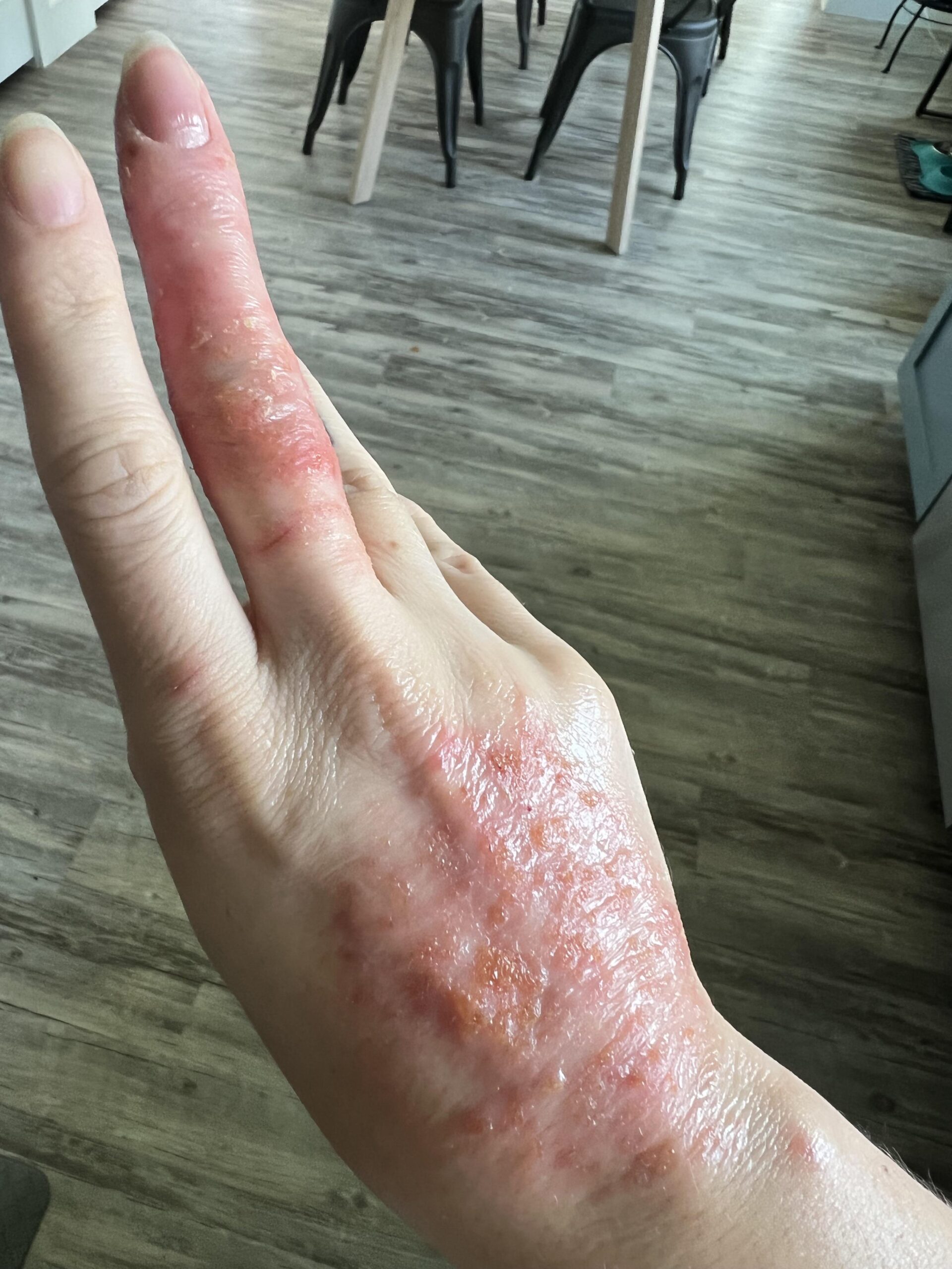 Αλλεργικά εξανθήματα: Οι τρόποι να τα αναγνωρίσεις πότε πρέπει να σε ανησυχήσουν και η αντιμετώπιση