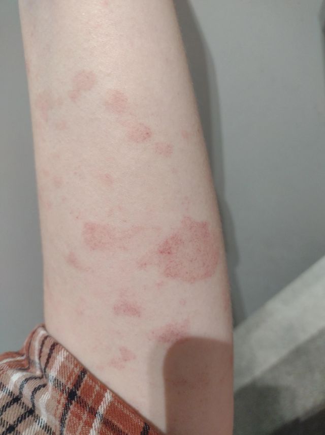 Αλλεργικά εξανθήματα: Οι τρόποι να τα αναγνωρίσεις πότε πρέπει να σε ανησυχήσουν και η αντιμετώπιση