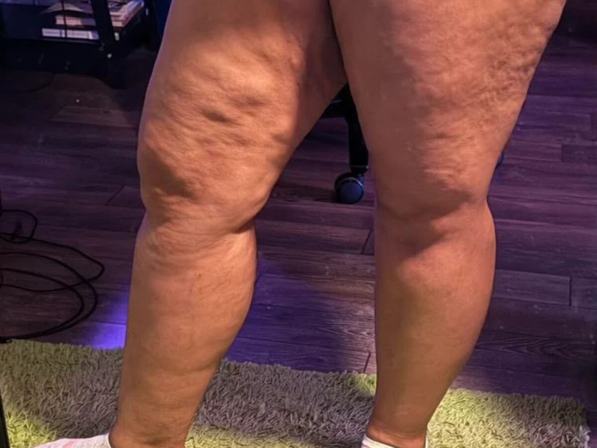 Αναλυτικός οδηγός για διατροφή κατά τις κυτταρίτιδας από διατροφολόγο 