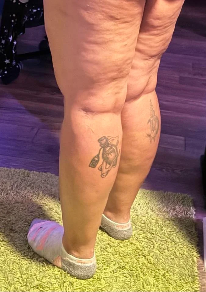 Διατροφή για κυτταρίτιδα: Πώς βοηθάει να απαλλαγούμε και τί είναι ακριβώς