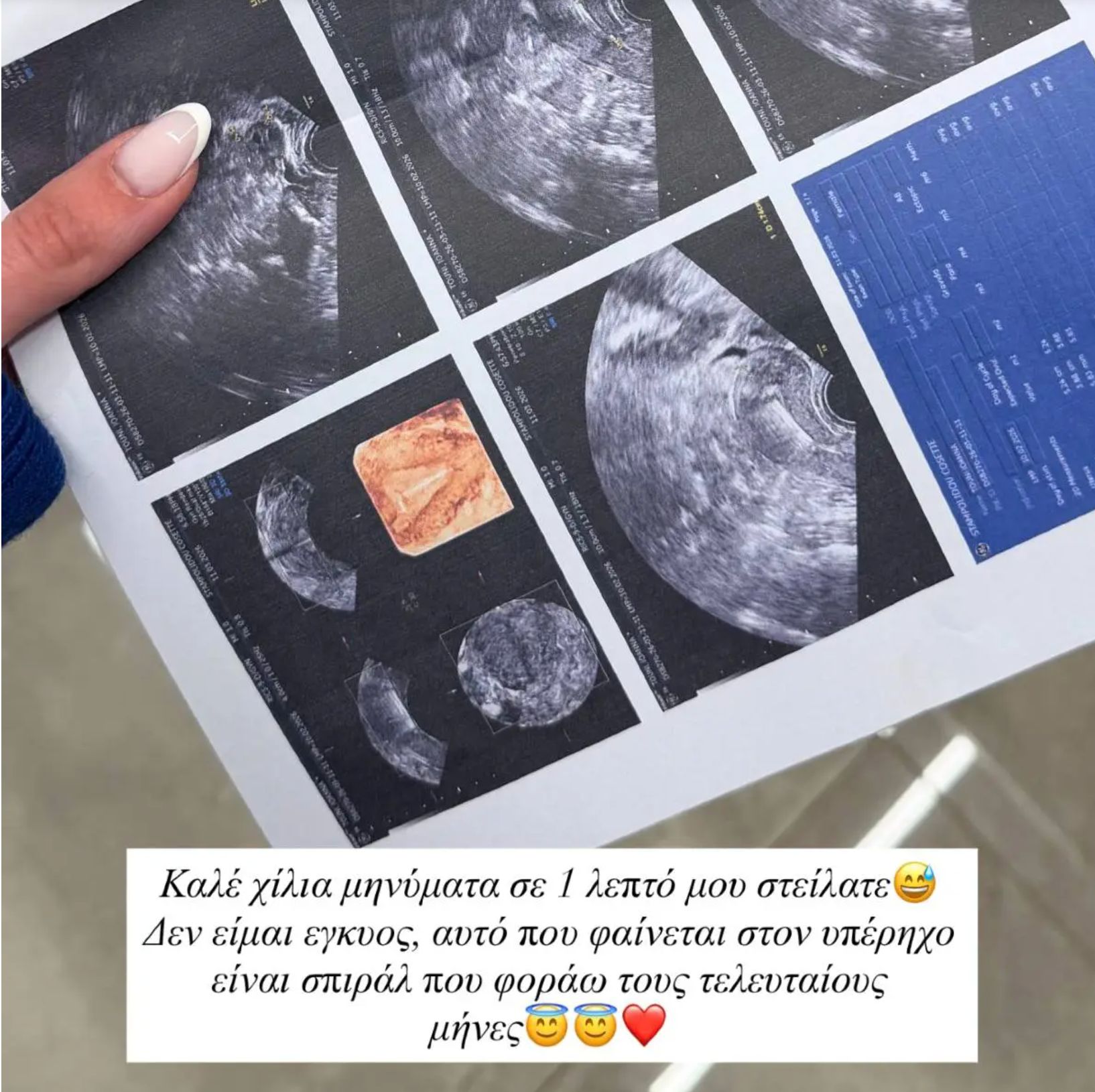 Είναι έγκυος η Ιωάννα Τούνη; Ο υπέρηχος που φούντωσε τις φήμες