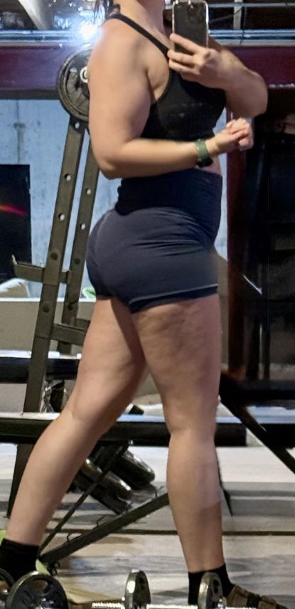 Κυτταρίτιδα ή λιποίδημα ; Δες τις διαφορές