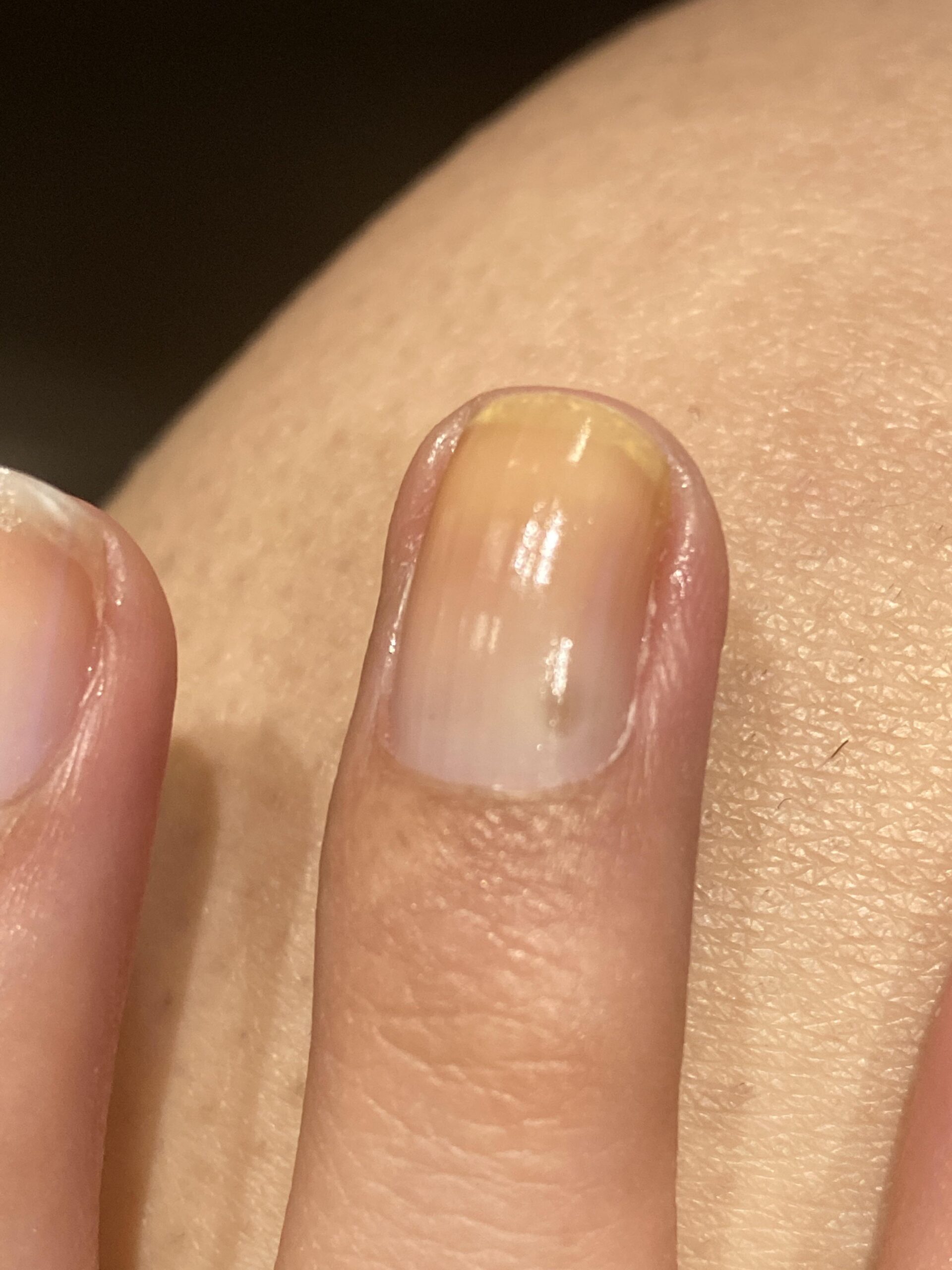 Χτιστά νύχια: Τί πρέπει να αποφύγεις για να μη βγάλεις μύκητες