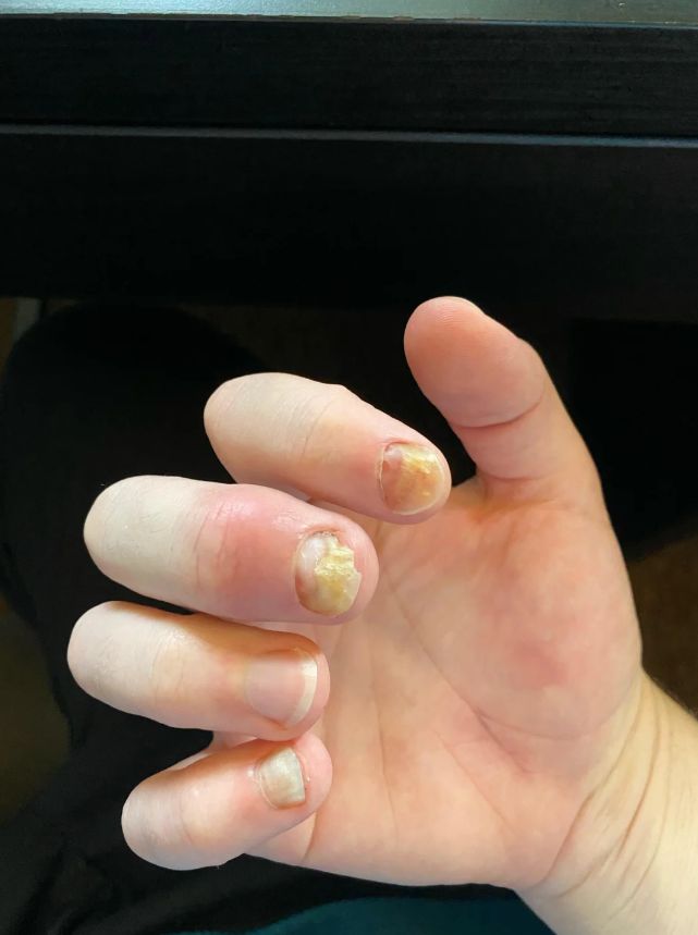 Χτιστά νύχια: Τί πρέπει να αποφύγεις για να μη βγάλεις μύκητες