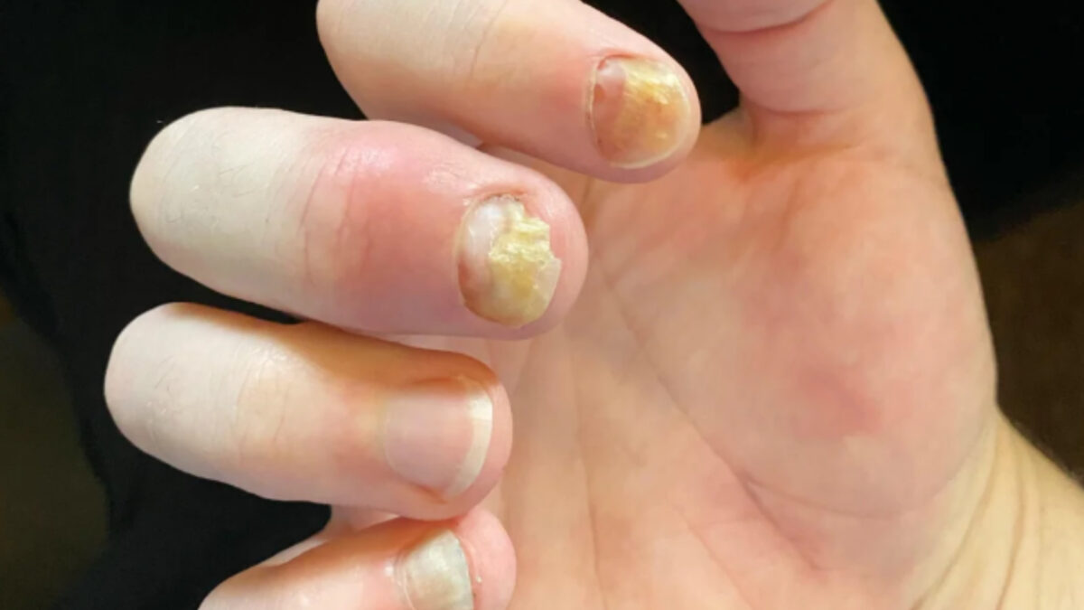 Χτιστά νύχια: Τί πρέπει να αποφύγεις για να μη βγάλεις μύκητες