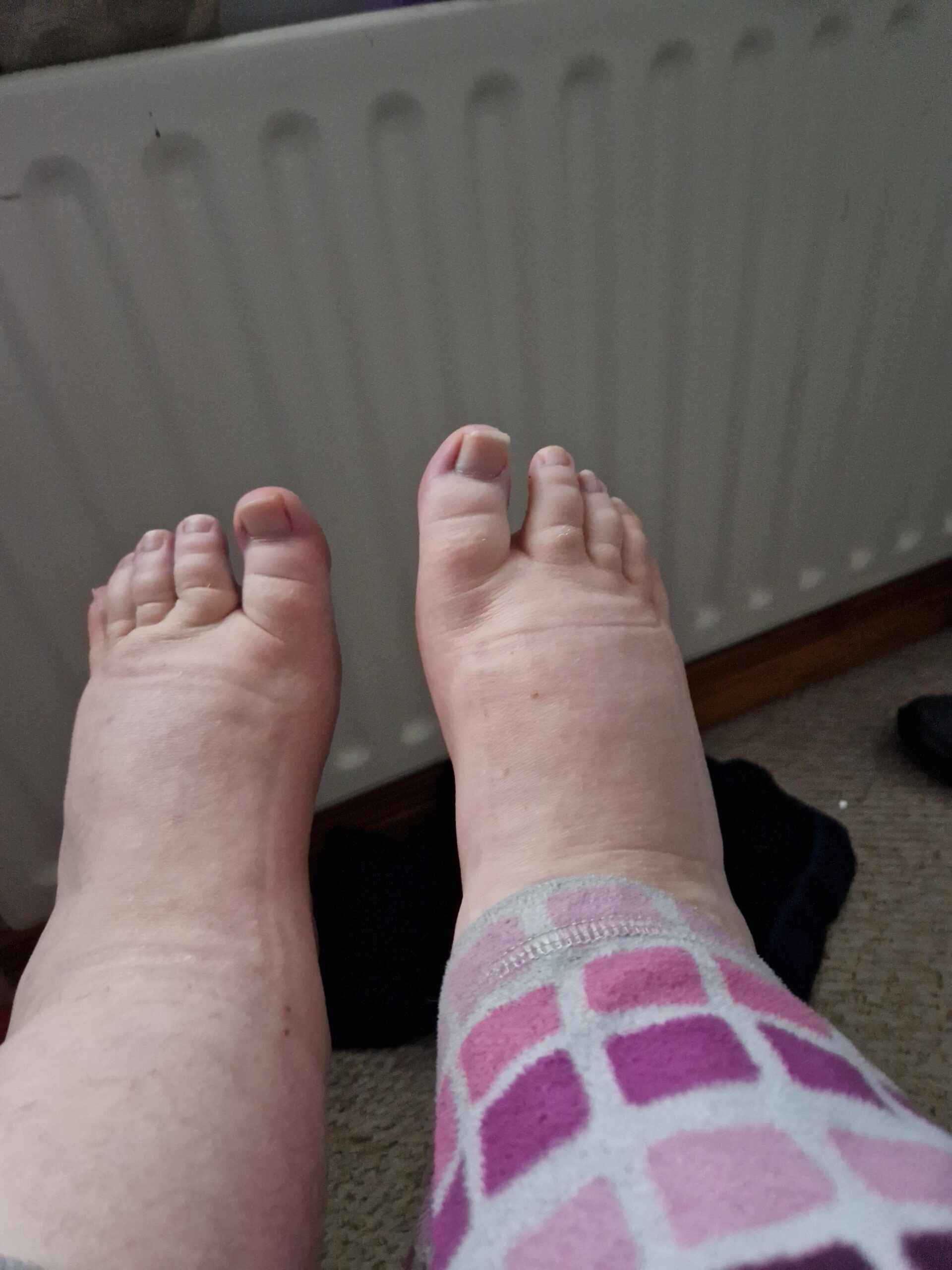 Τα άγνωστα και φαινομενικά ακίνδυνα συμπτώματα της θρόμβωσης