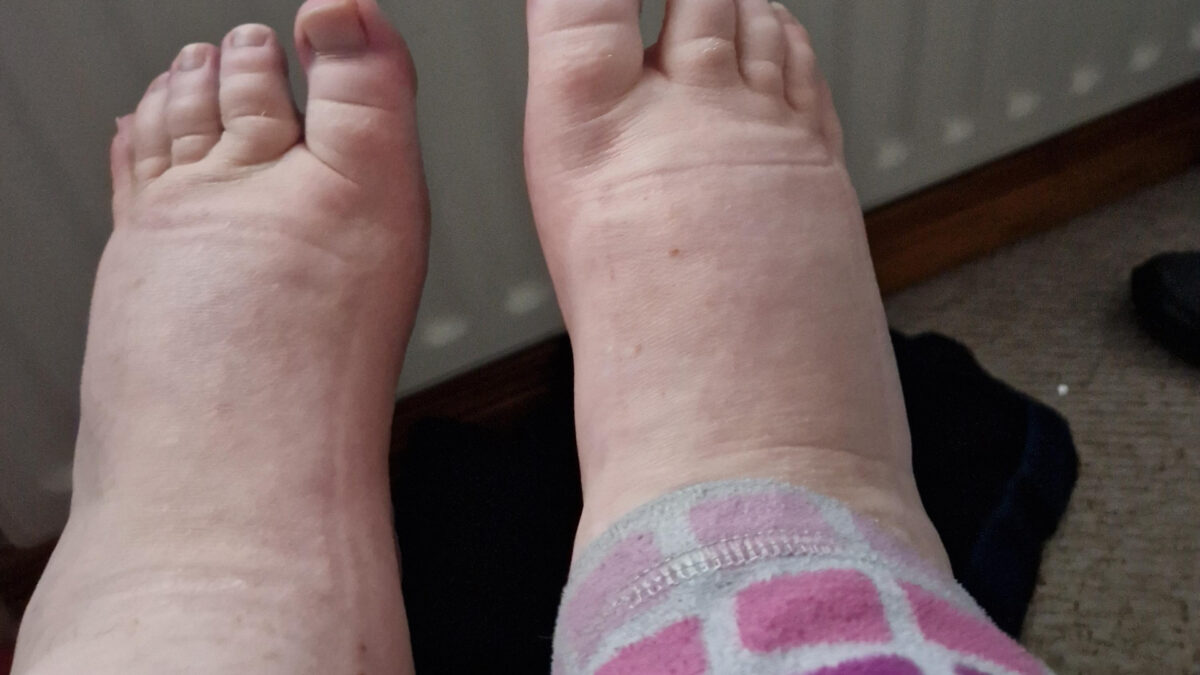 Τα άγνωστα και φαινομενικά ακίνδυνα συμπτώματα της θρόμβωσης