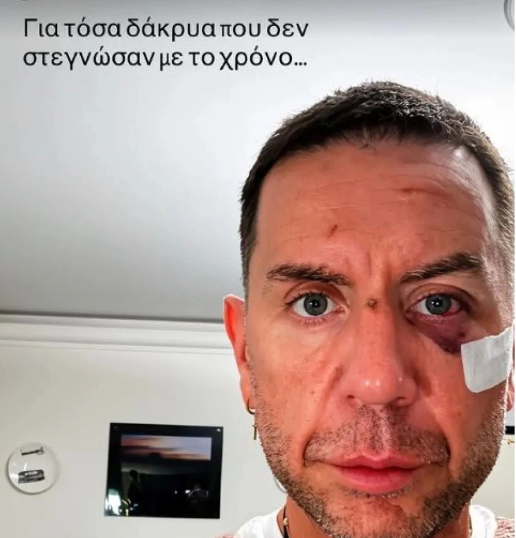 Γιώργος Μαζωνάκης: Η φωτογραφία με τραύματα στο πρόσωπο που ανησύχησε