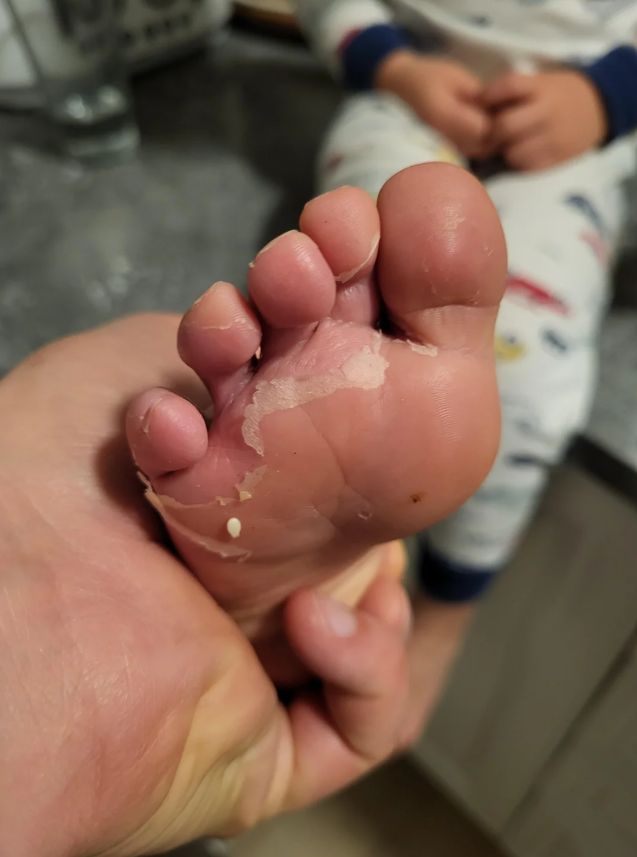 Ξεφλούδισμα στα πόδια και τα δάχτυλα των παιδιών μετά τη θάλασσα ή την πισίνα: Τα αίτια και πότε πρέπει να πάτε στον γιατρό