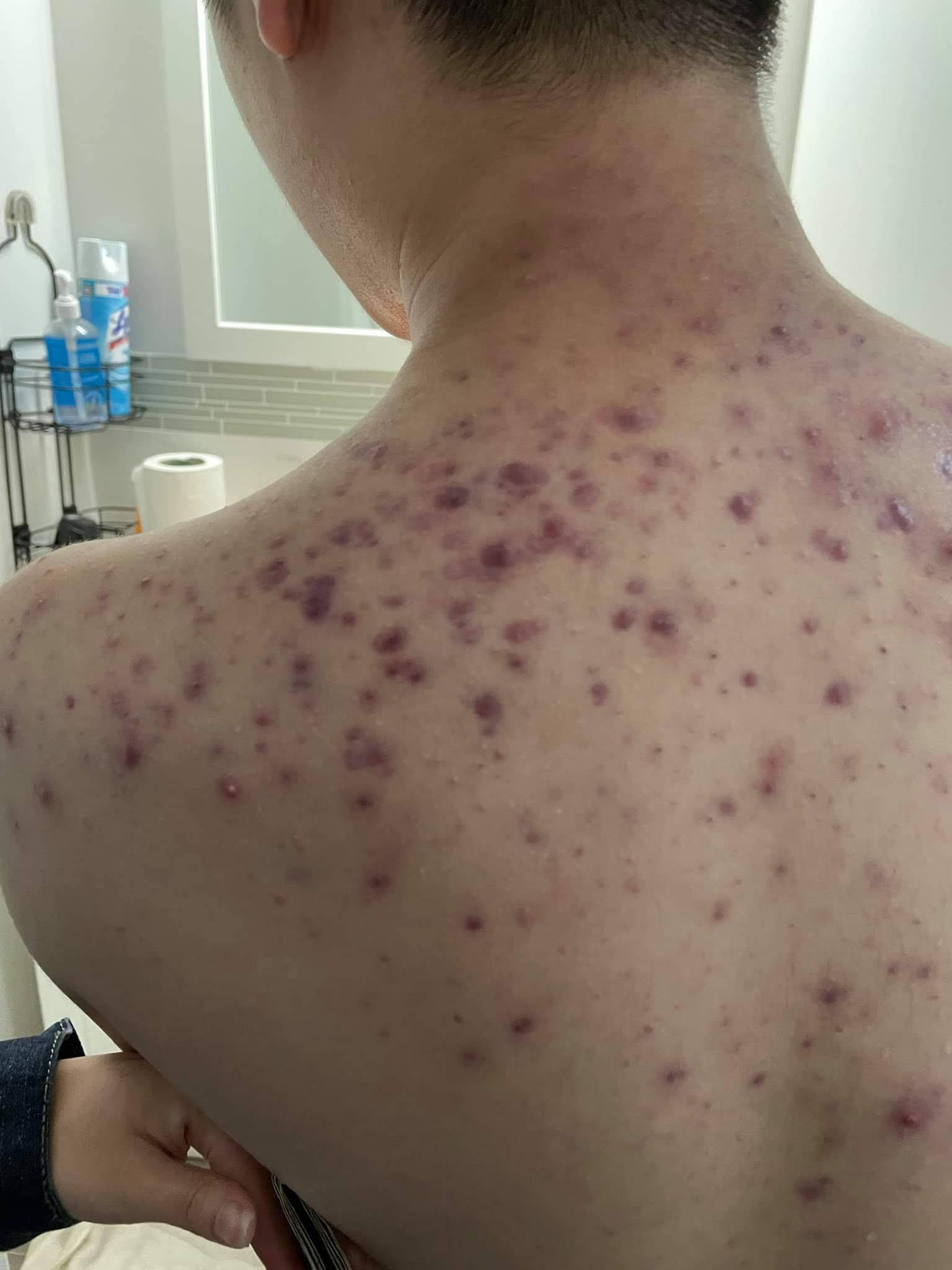 Σπυράκια σε πλάτη και γλουτούς το καλοκαίρι: Γιατί βγαίνουν από τον ιδρώτα και η σπιτική κρέμα που θα τα εξαφανίσει